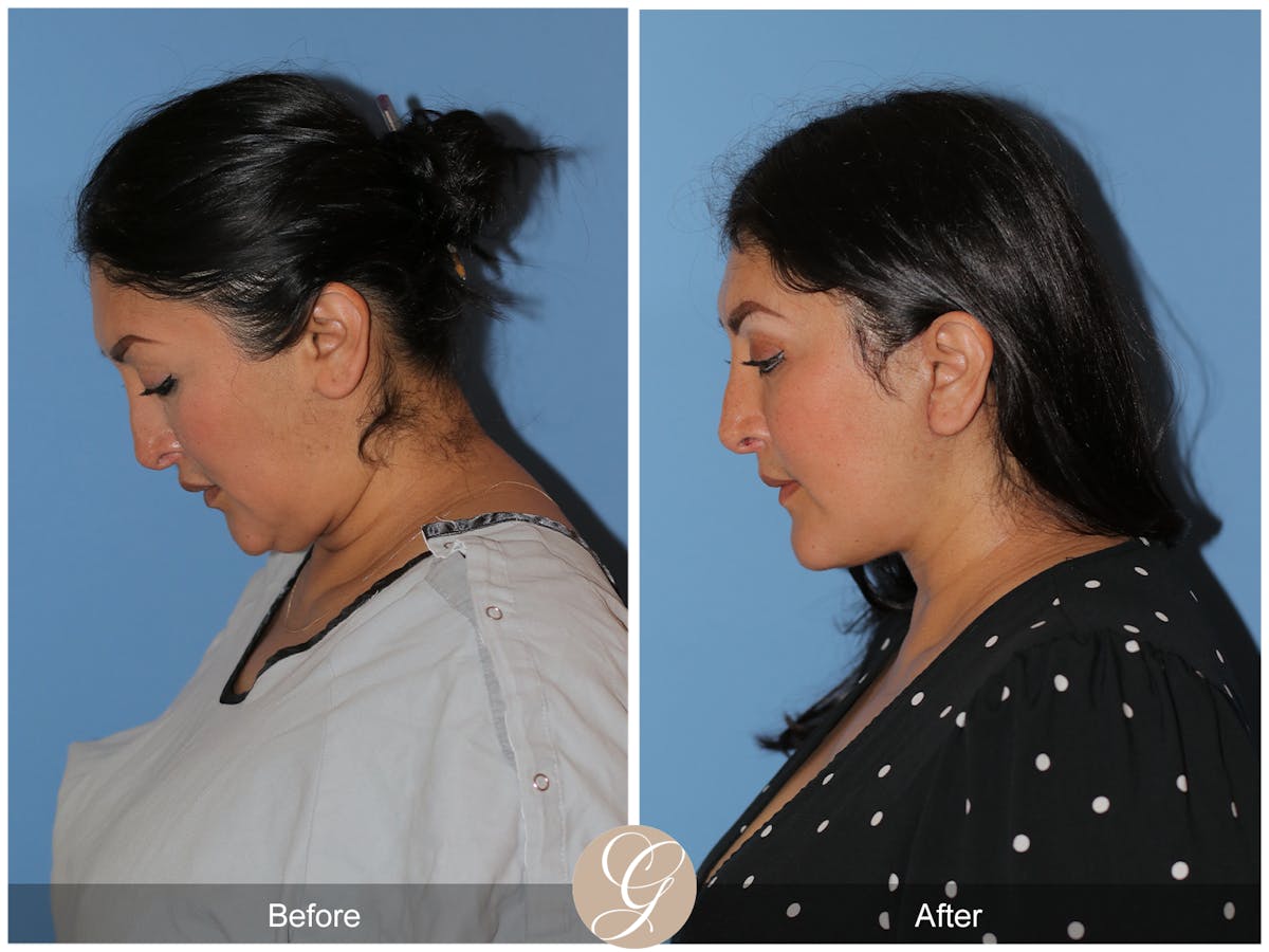 Deep Plane Facelift Before & After Gallery - Patient 292666 - Image 6