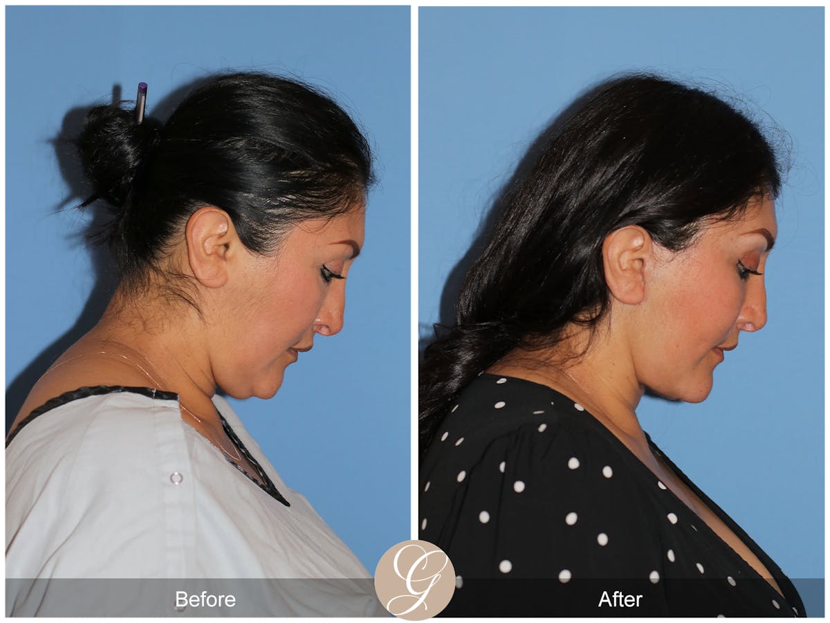 Deep Plane Facelift Before & After Gallery - Patient 292666 - Image 8