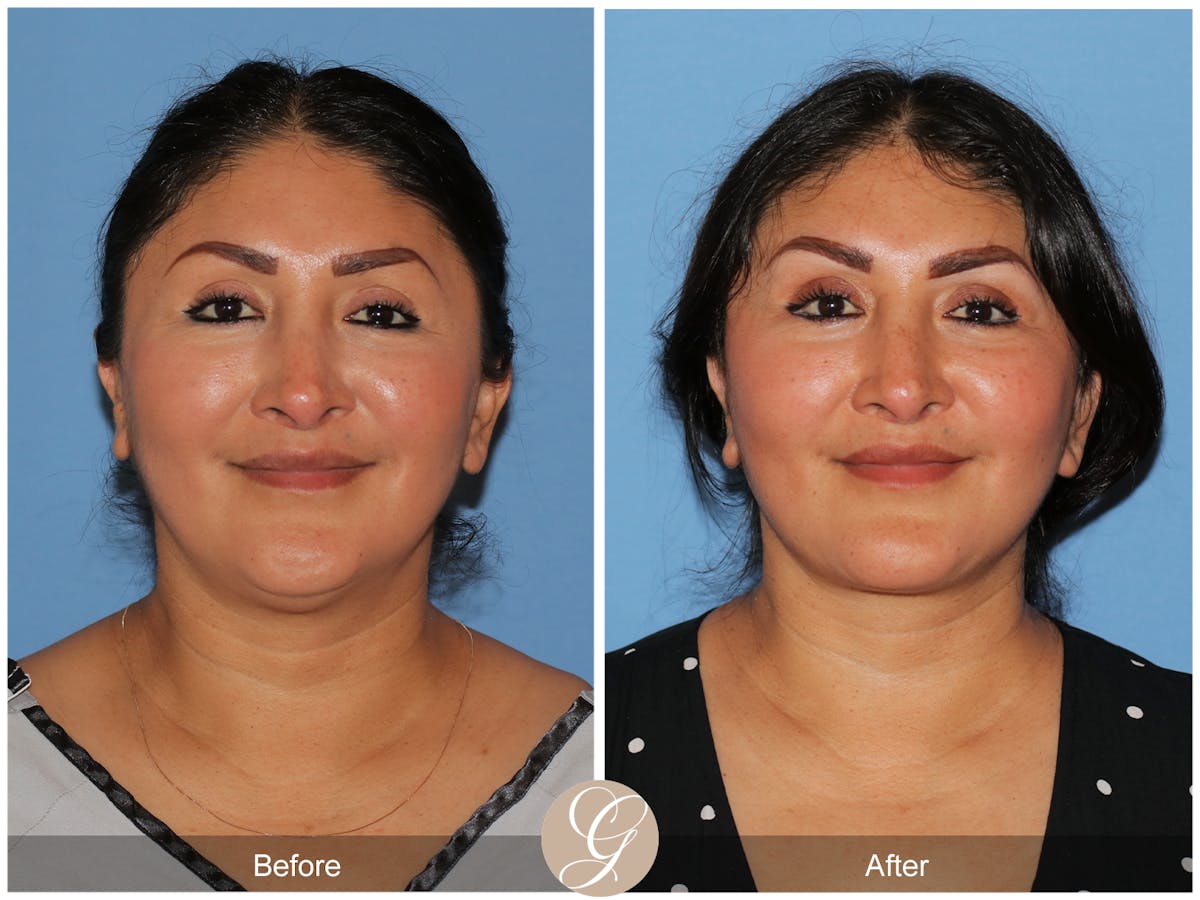 Deep Plane Facelift Before & After Gallery - Patient 292666 - Image 2