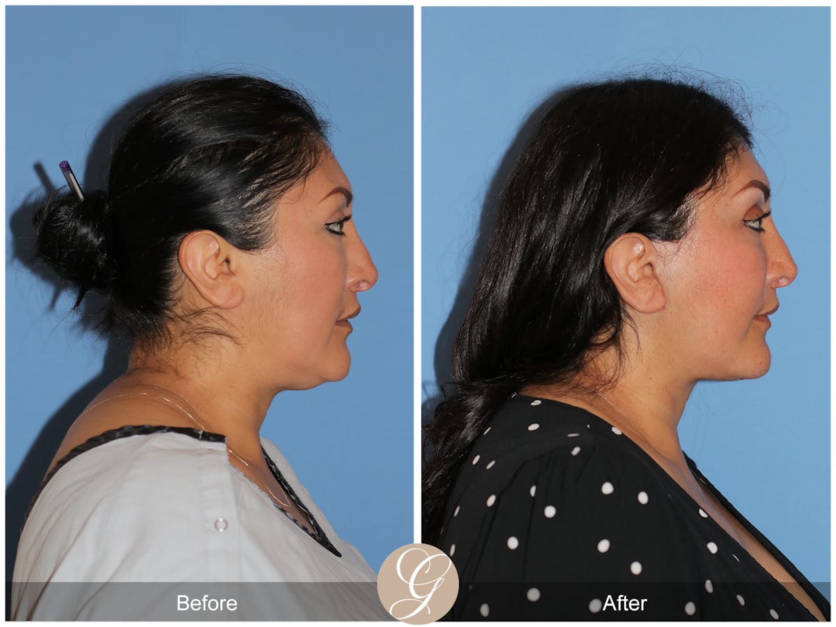 Deep Plane Facelift Before & After Gallery - Patient 292666 - Image 9
