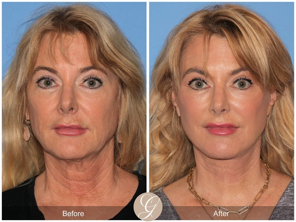 Deep Plane Facelift Before & After Gallery - Patient 223503 - Image 1