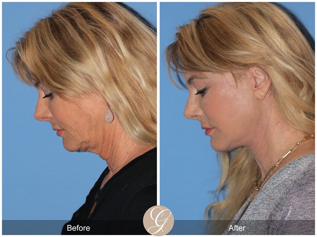 Deep Plane Facelift Before & After Gallery - Patient 223503 - Image 2