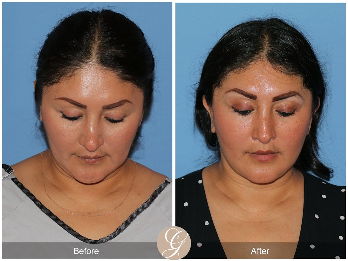 Deep Plane Facelift Before & After Gallery - Patient 292666 - Image 3