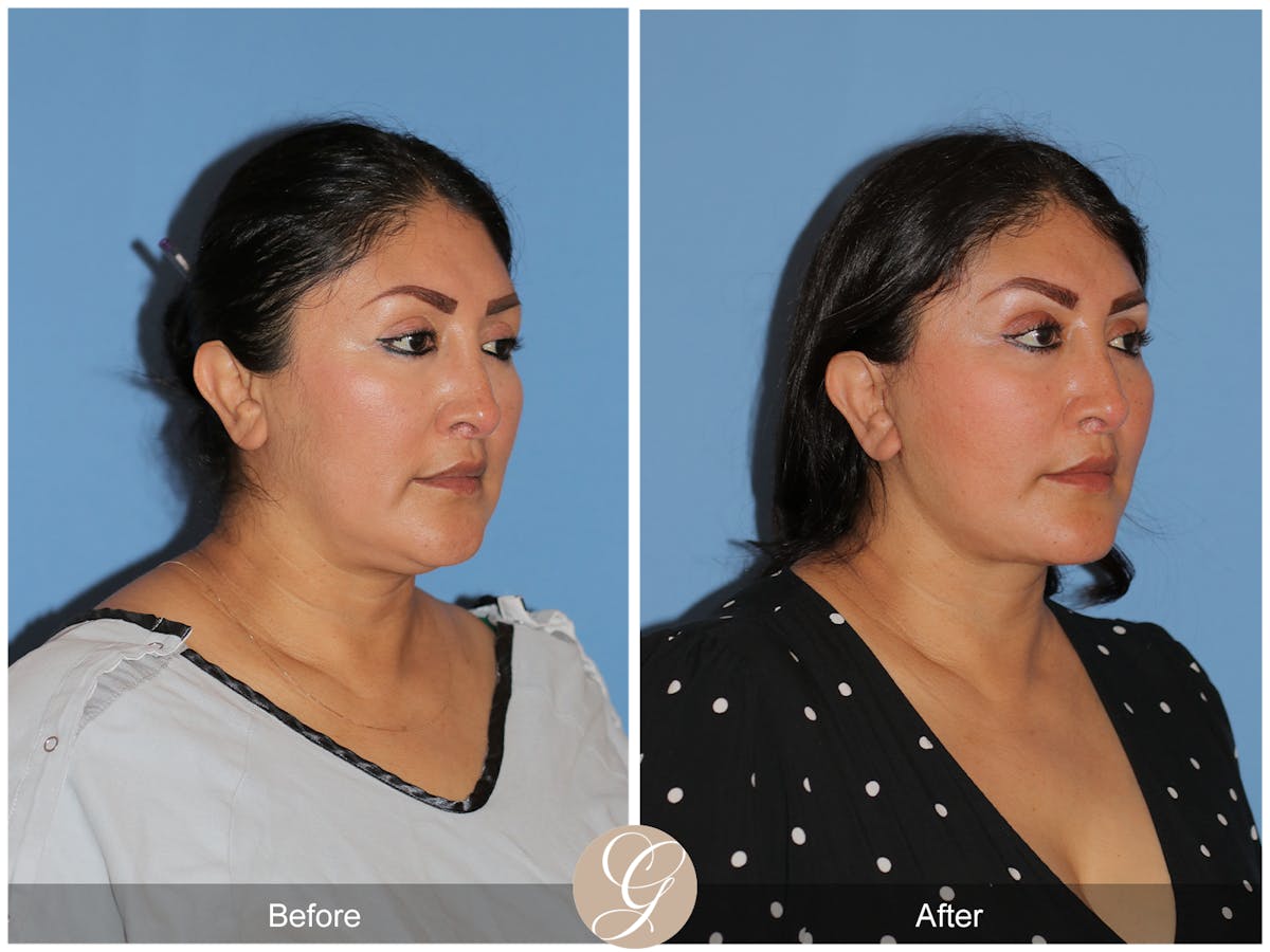 Deep Plane Facelift Before & After Gallery - Patient 292666 - Image 5