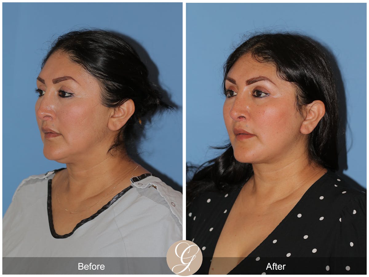 Deep Plane Facelift Before & After Gallery - Patient 292666 - Image 4