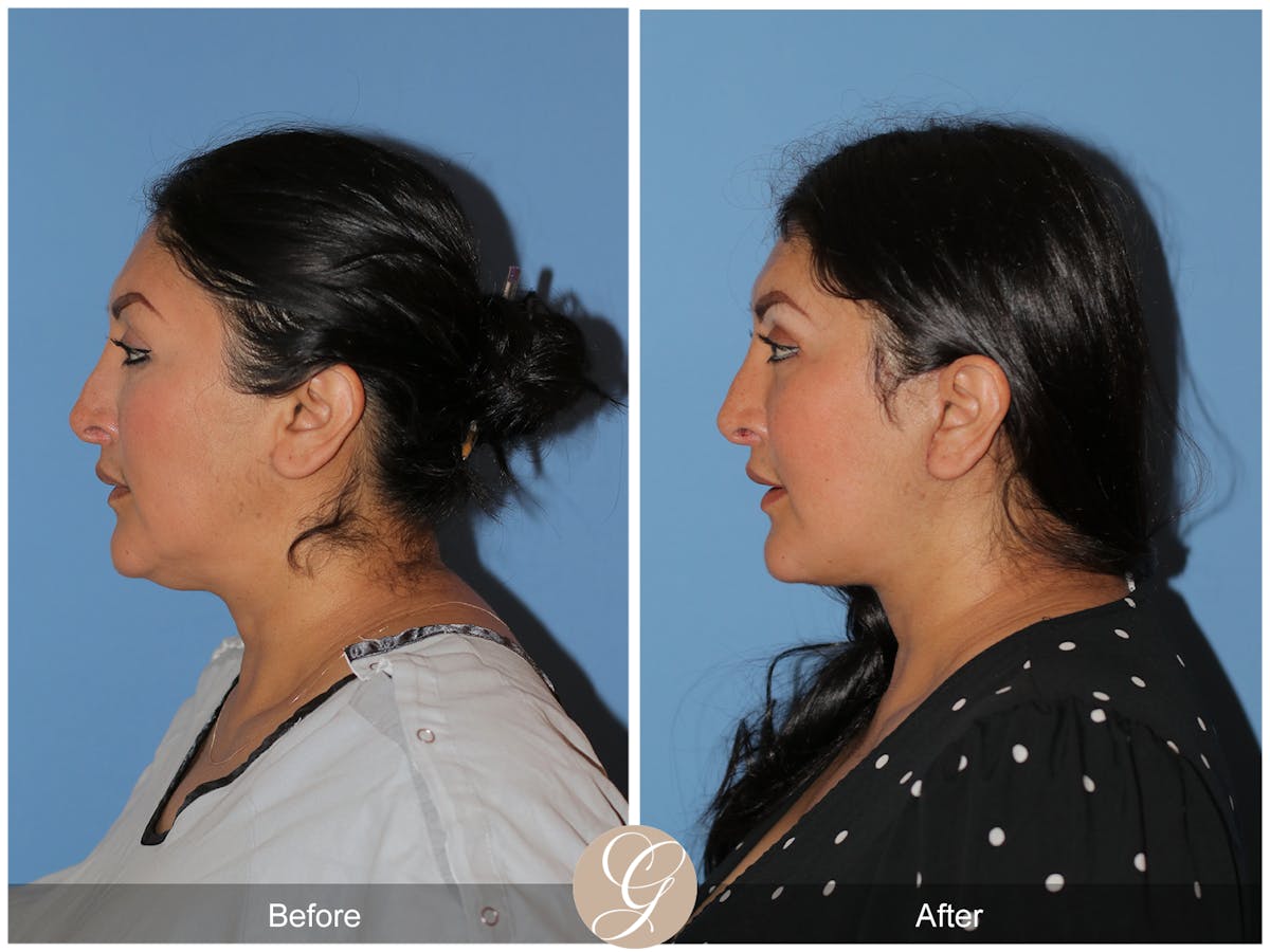 Deep Plane Facelift Before & After Gallery - Patient 292666 - Image 7