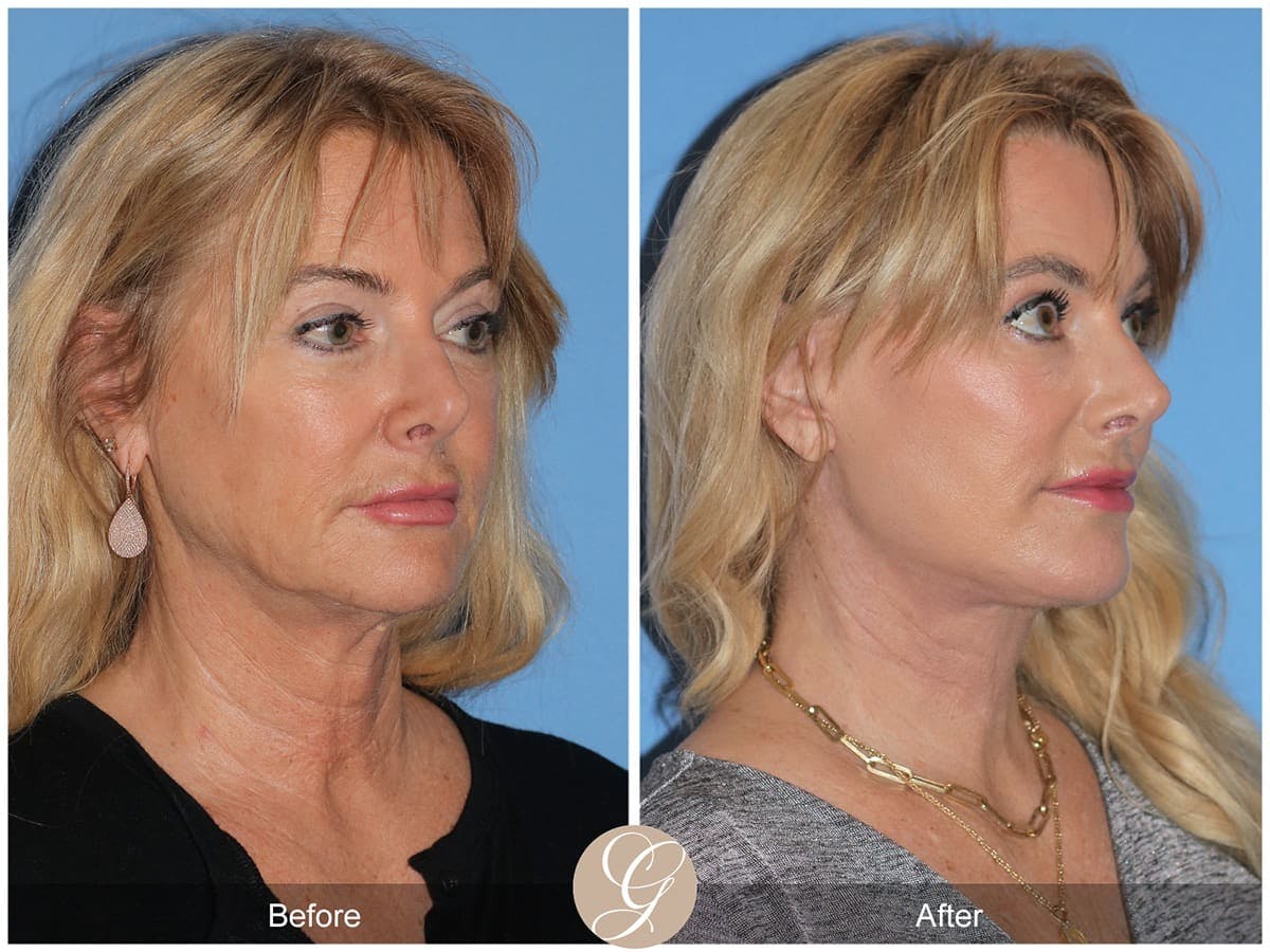 Deep Plane Facelift Before & After Gallery - Patient 223503 - Image 3