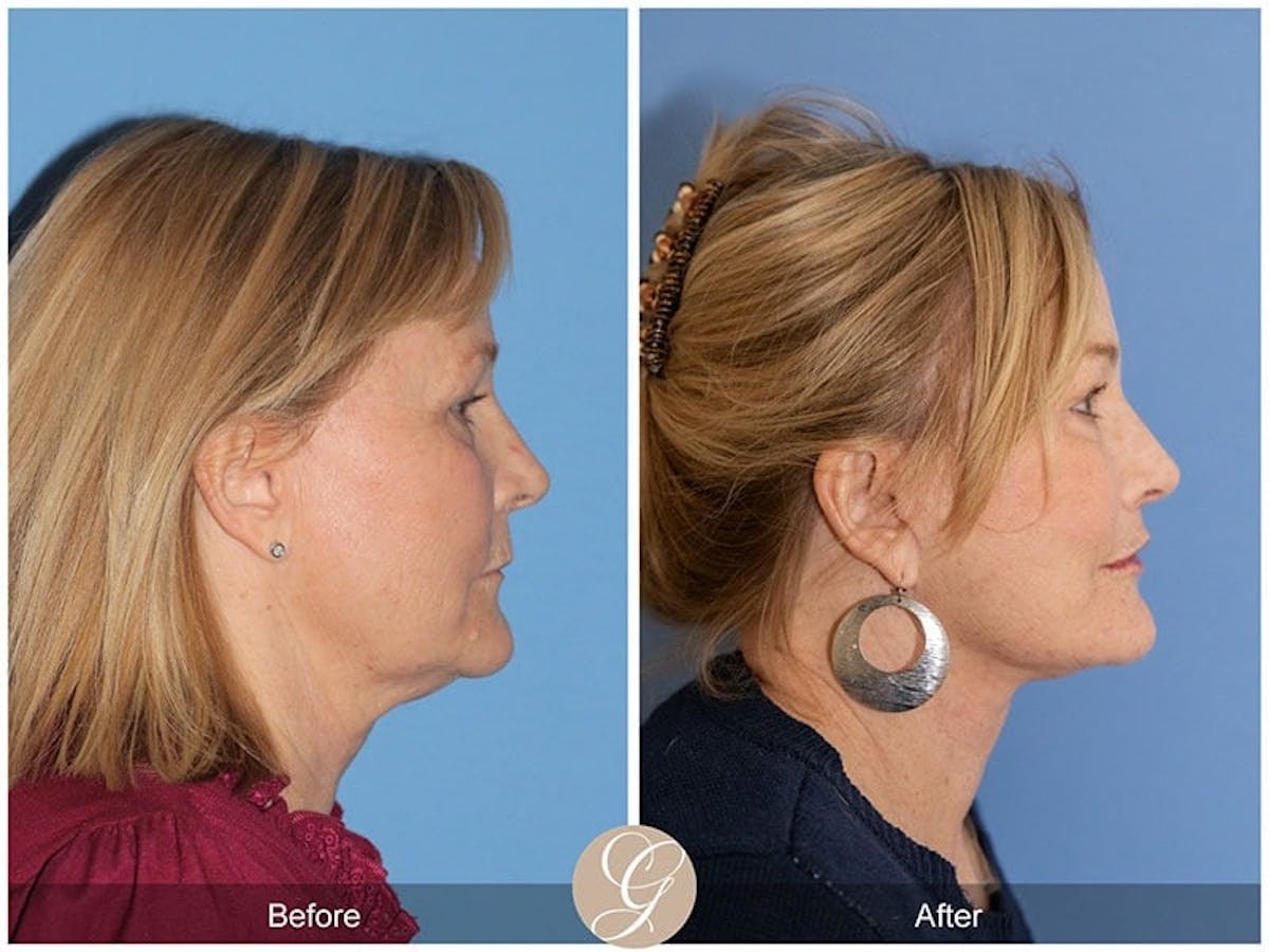 Deep Plane Facelift Before & After Gallery - Patient 302224 - Image 2