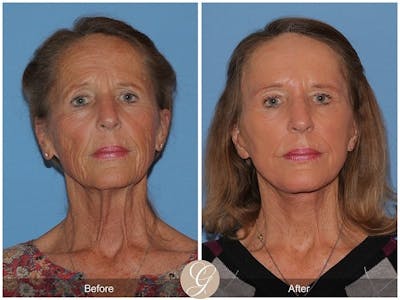 Deep Plane Facelift Before & After Gallery - Patient 118623 - Image 1