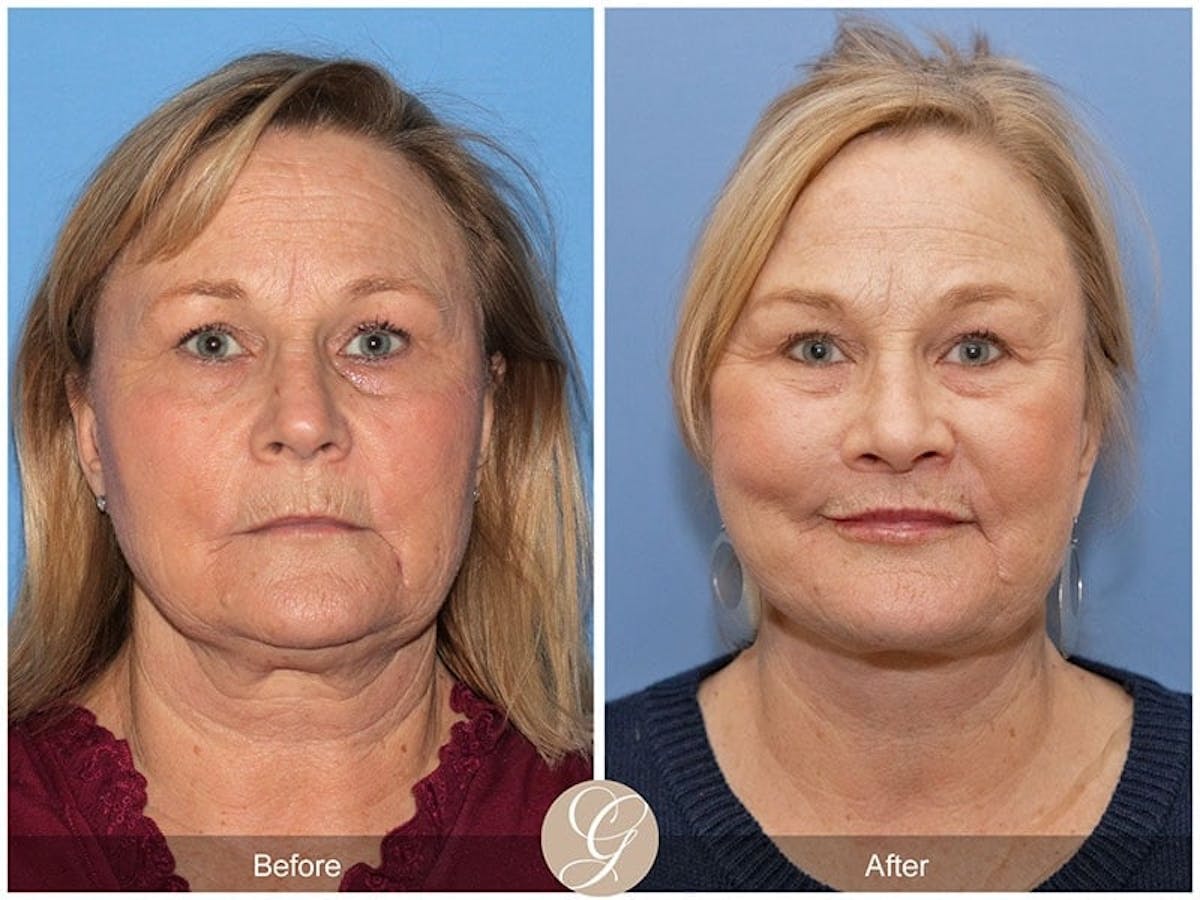 Deep Plane Facelift Before & After Gallery - Patient 302224 - Image 1