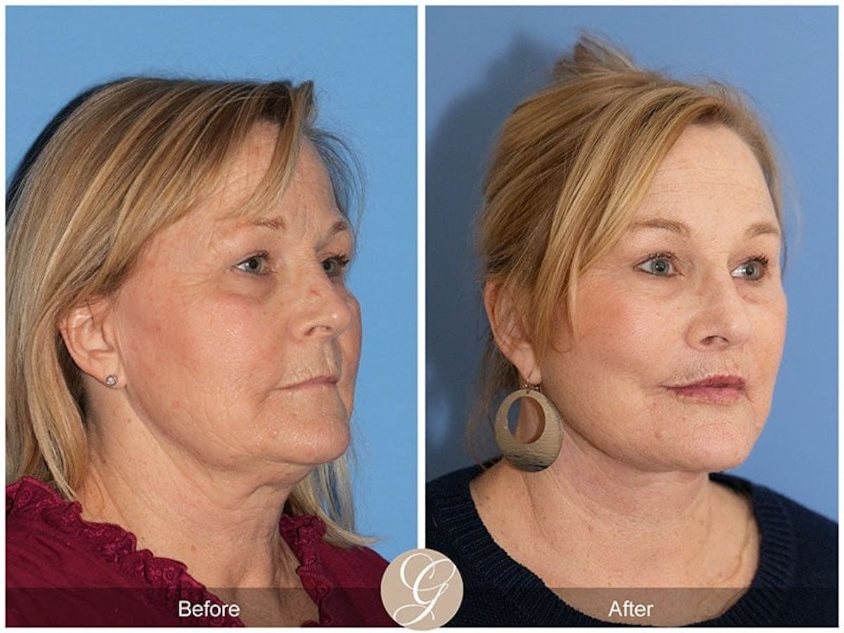 Deep Plane Facelift Before & After Gallery - Patient 302224 - Image 3