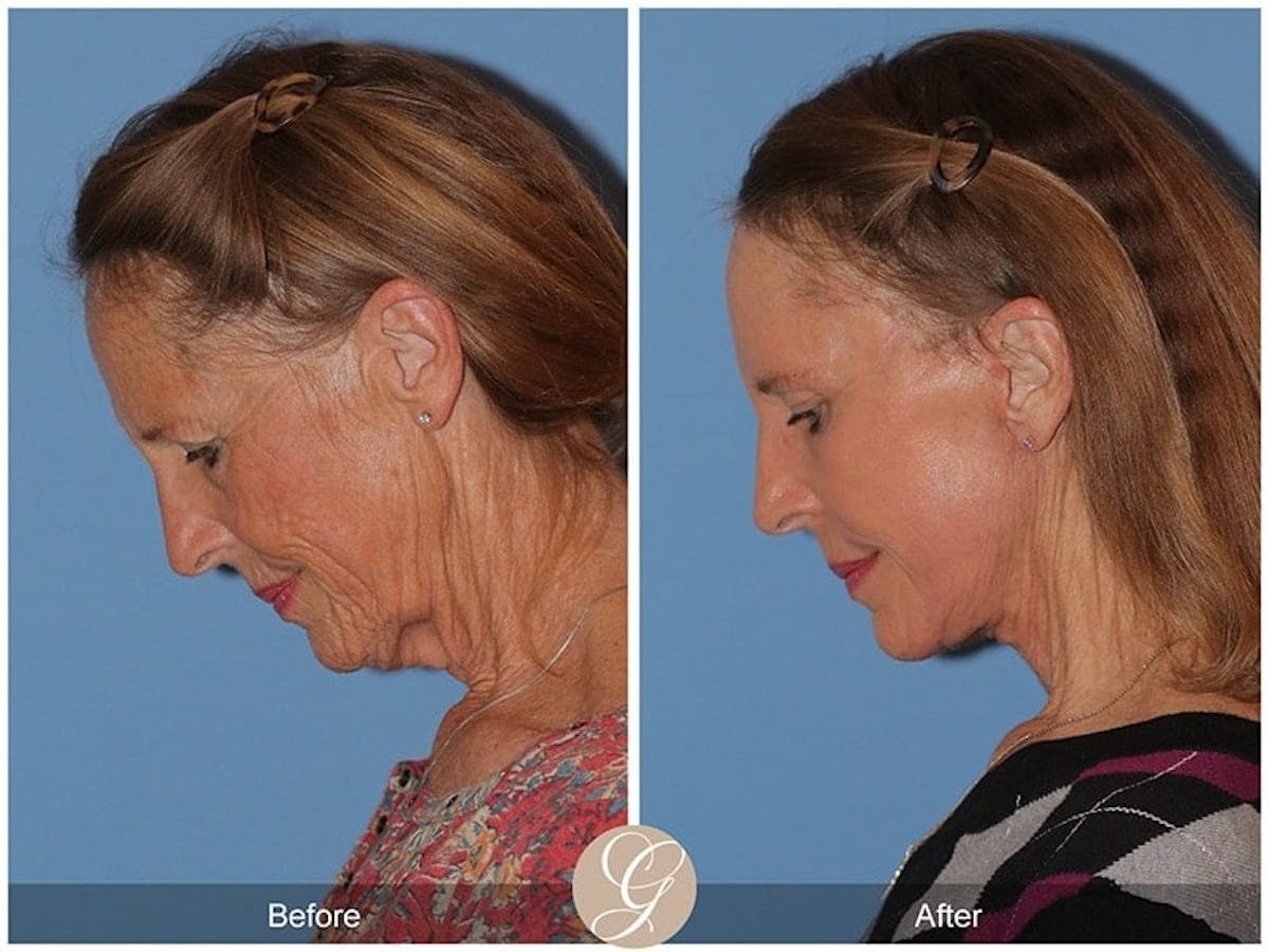Deep Plane Facelift Before & After Gallery - Patient 118623 - Image 2
