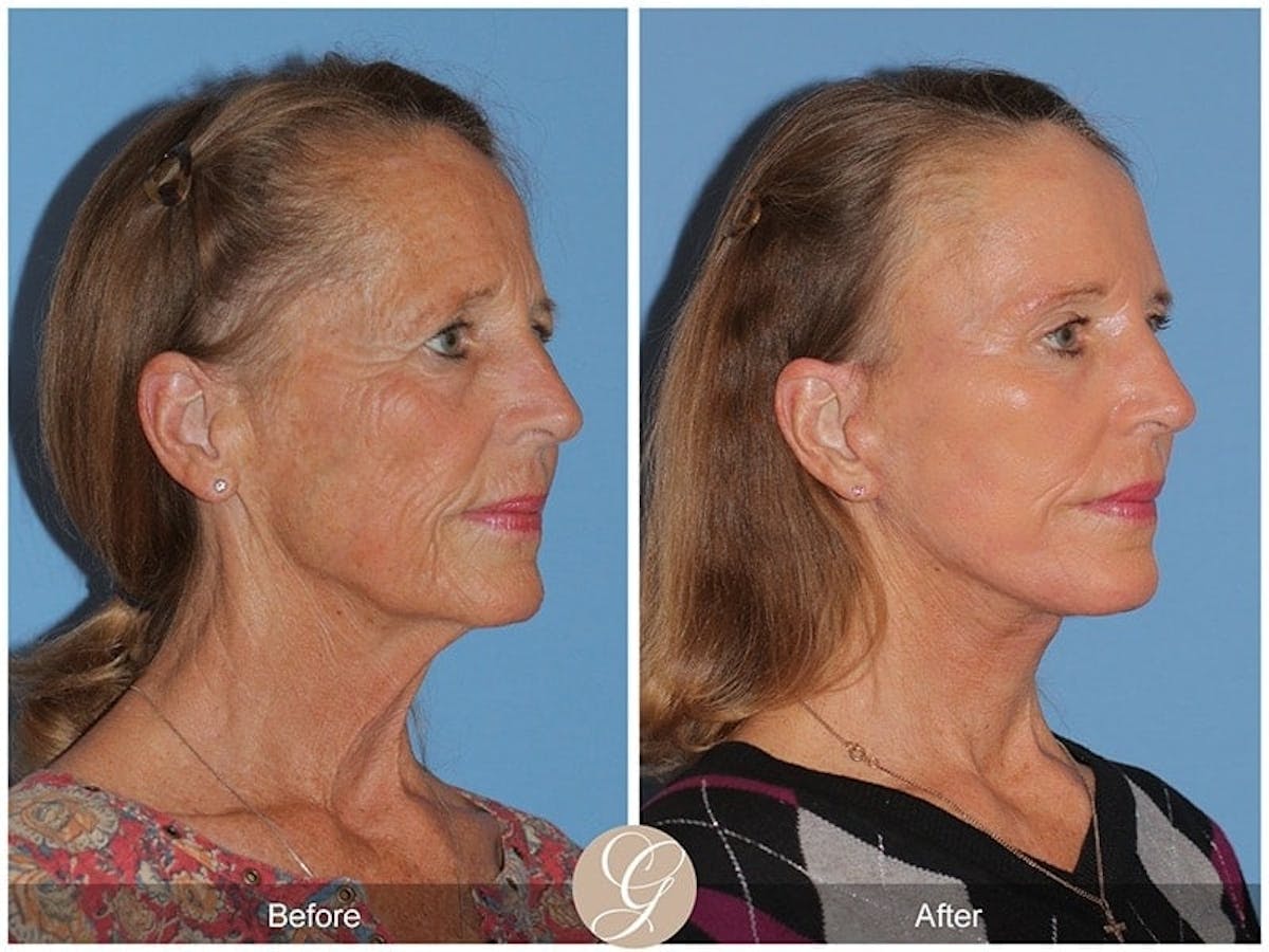 Deep Plane Facelift Before & After Gallery - Patient 118623 - Image 3