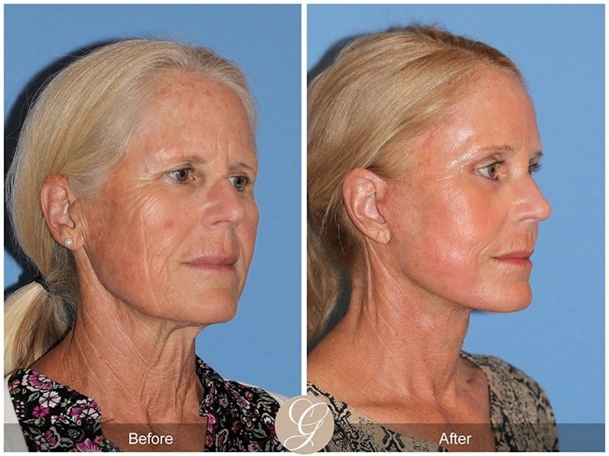 Deep Plane Facelift Before & After Gallery - Patient 342069 - Image 3