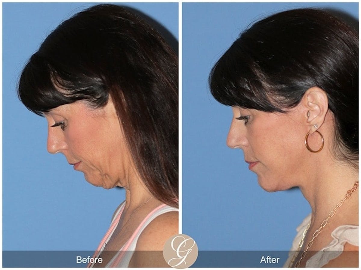 Preservation Facelift Before & After Gallery - Patient 376938 - Image 2