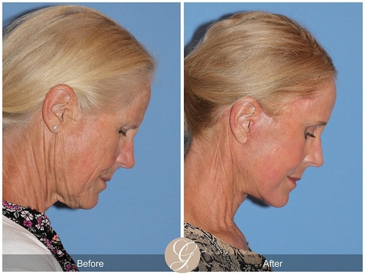 Deep Plane Facelift Before & After Gallery - Patient 342069 - Image 2