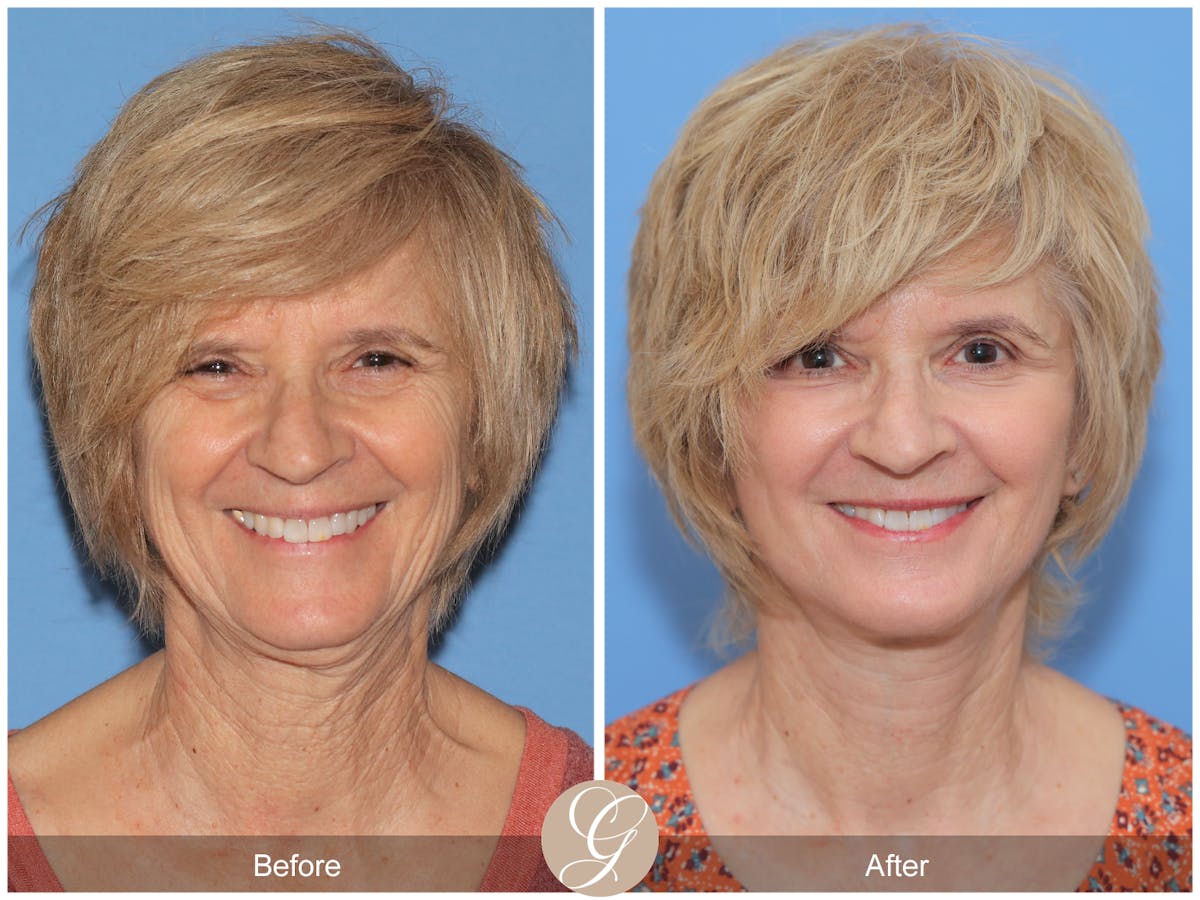 Deep Plane Facelift Before & After Gallery - Patient 386884 - Image 4