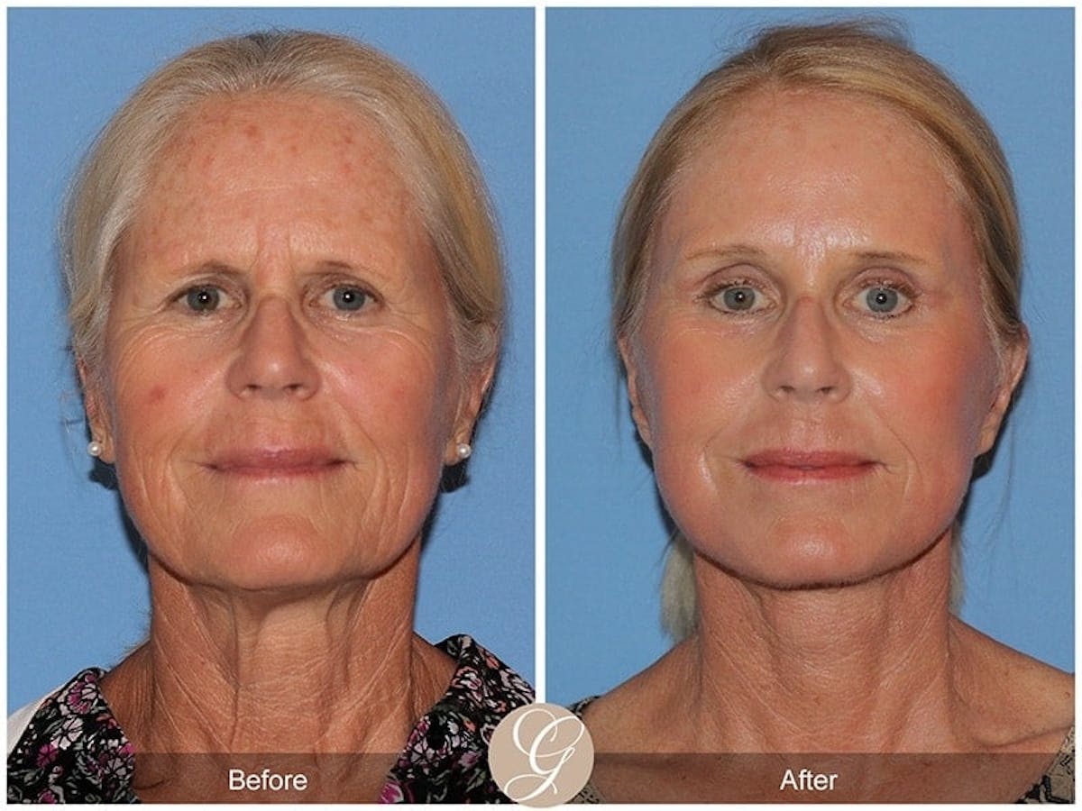 Deep Plane Facelift Before & After Gallery - Patient 342069 - Image 1
