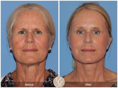 Deep Plane Facelift Before & After Gallery - Patient 342069 - Image 1