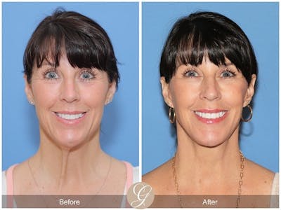 Preservation Facelift Before & After Gallery - Patient 376938 - Image 1