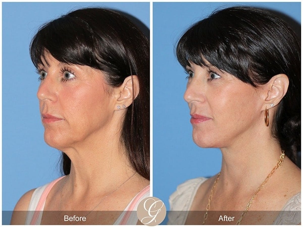 Preservation Facelift Before & After Gallery - Patient 376938 - Image 3