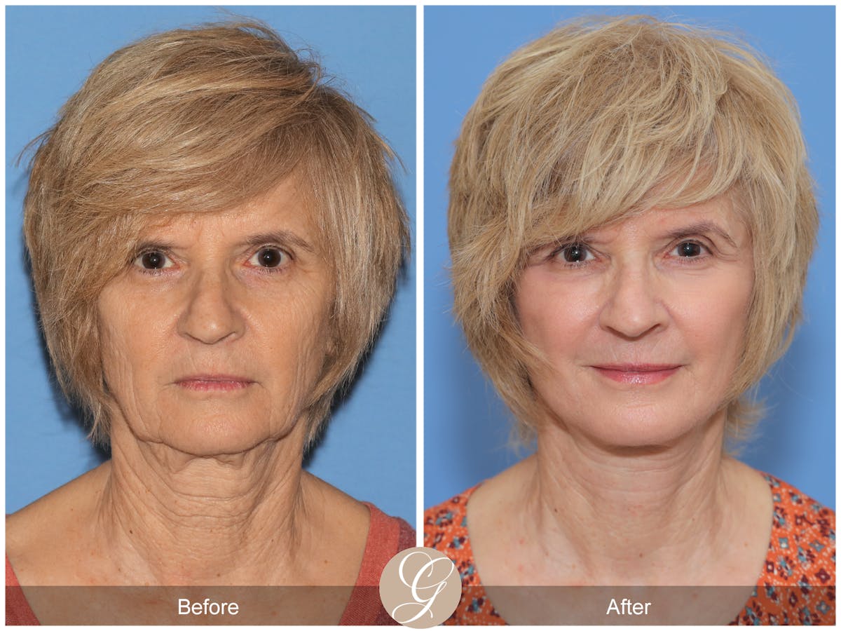 Deep Plane Facelift Before & After Gallery - Patient 386884 - Image 1