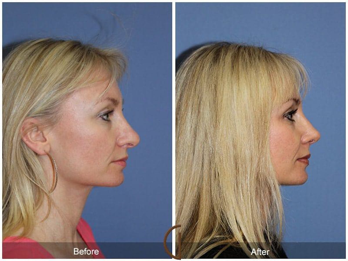 Tip Rhinoplasty Before & After Gallery - Patient 728382 - Image 3