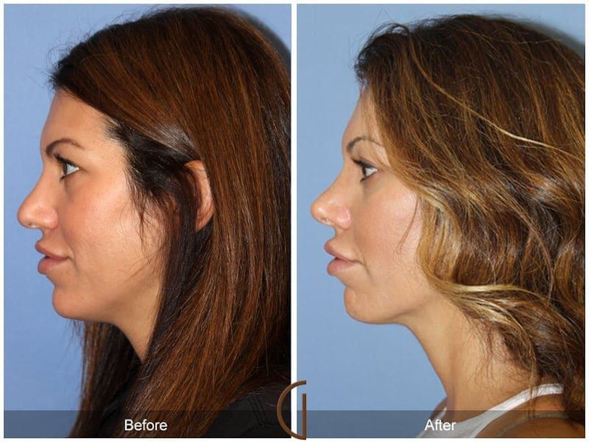 Tip Rhinoplasty Before & After Gallery - Patient 380023 - Image 1