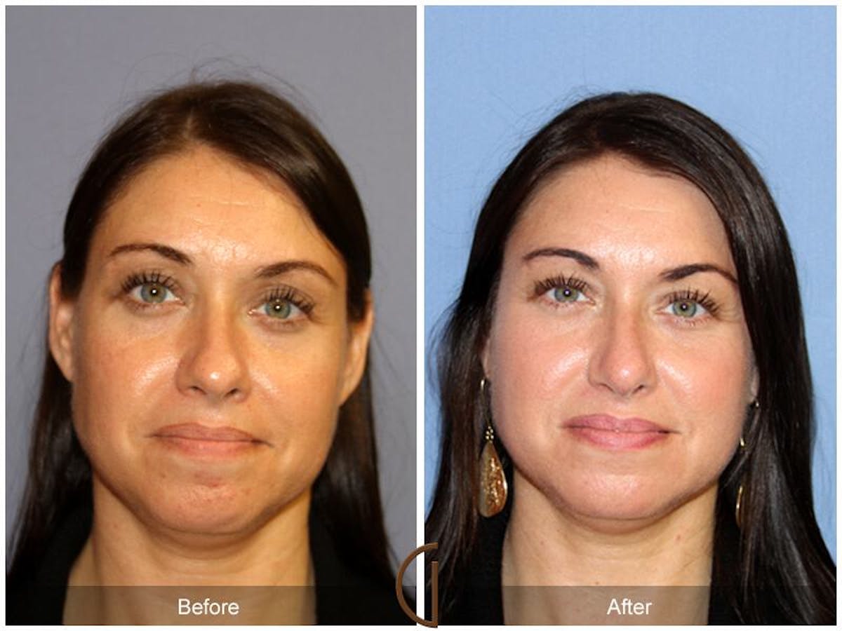 Tip Rhinoplasty Before & After Gallery - Patient 131146 - Image 2