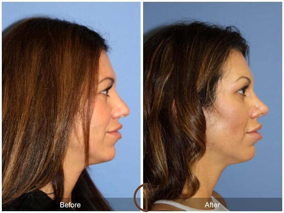 Tip Rhinoplasty Before & After Gallery - Patient 380023 - Image 3