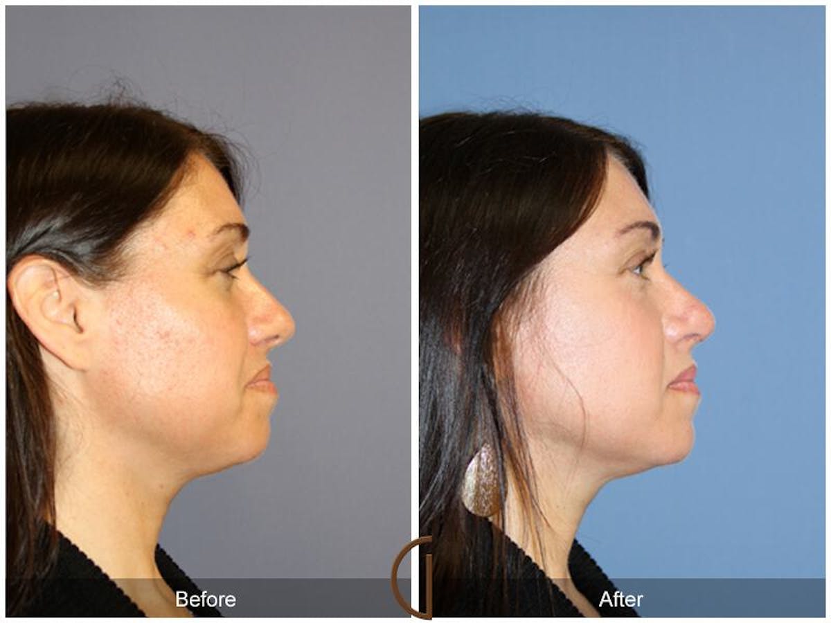 Tip Rhinoplasty Before & After Gallery - Patient 131146 - Image 3