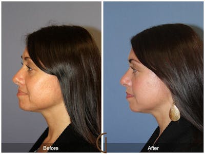 Tip Rhinoplasty Before & After Gallery - Patient 131146 - Image 1