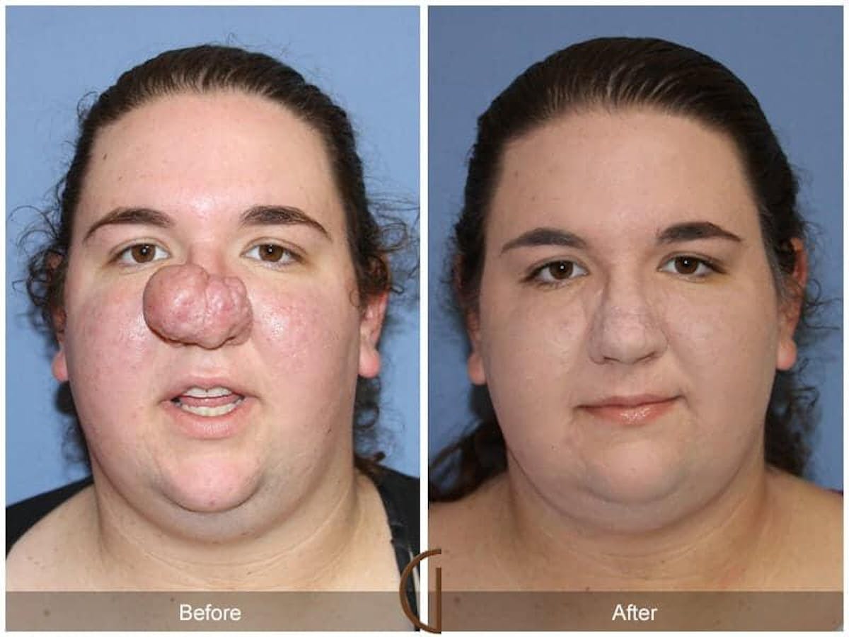 Tip Rhinoplasty Before & After Gallery - Patient 278833 - Image 2