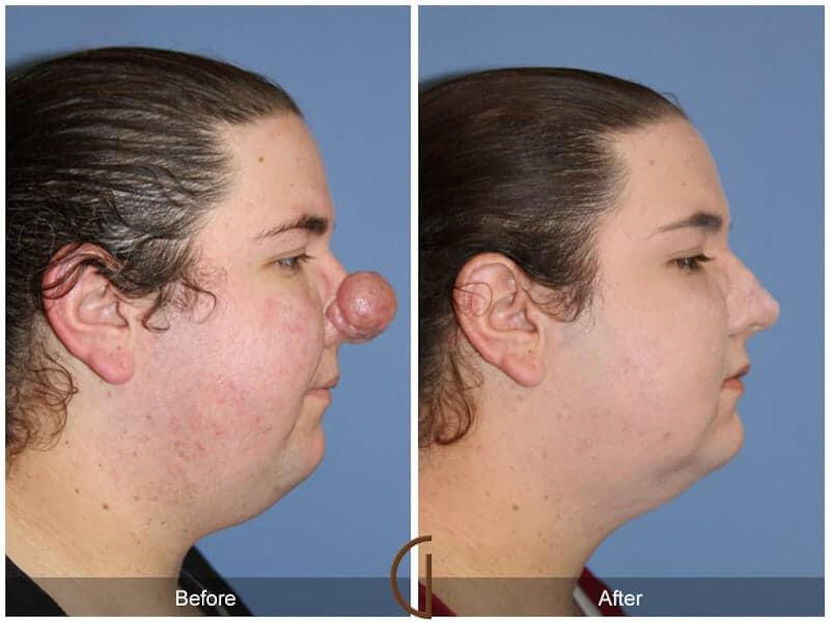 Tip Rhinoplasty Before & After Gallery - Patient 278833 - Image 3