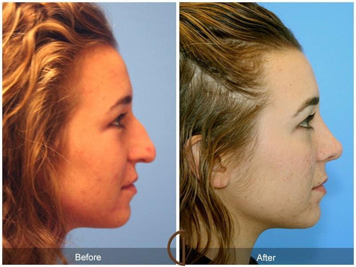 Tip Rhinoplasty Before & After Gallery - Patient 421350 - Image 3