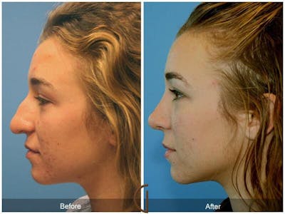 Tip Rhinoplasty Before & After Gallery - Patient 421350 - Image 1