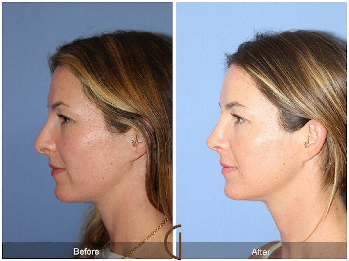 Tip Rhinoplasty Before & After Gallery - Patient 241604 - Image 1
