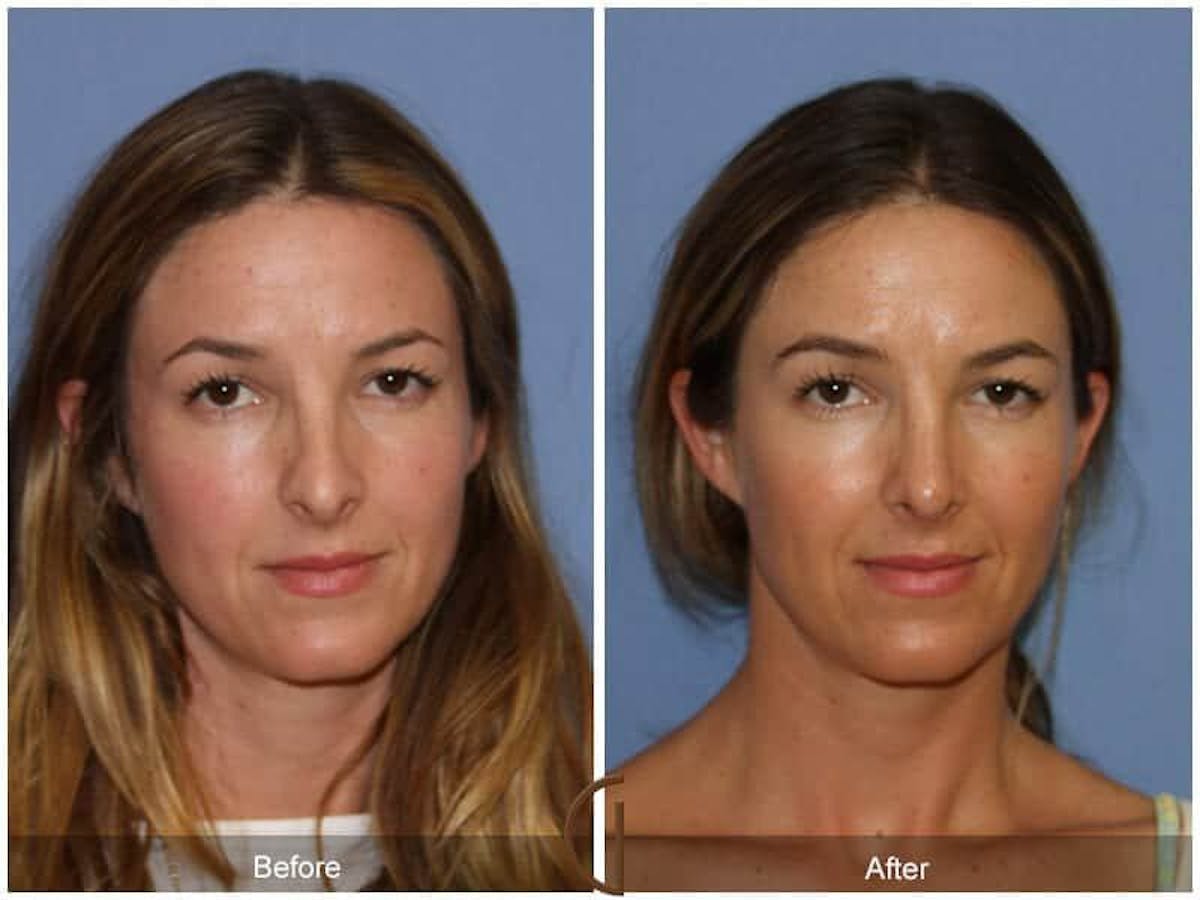 Tip Rhinoplasty Before & After Gallery - Patient 241604 - Image 2