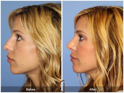 Revision Rhinoplasty Before & After Gallery - Patient 249360 - Image 1