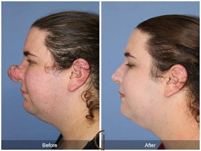 Tip Rhinoplasty Before & After Gallery - Patient 278833 - Image 1