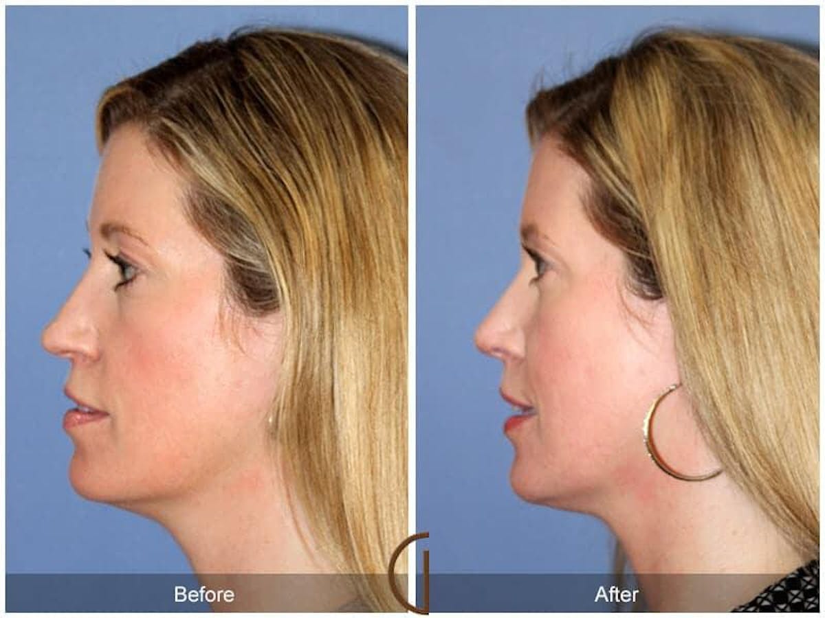 Tip Rhinoplasty Before & After Gallery - Patient 239604 - Image 1