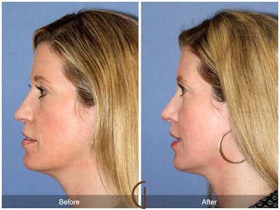 Tip Rhinoplasty Before & After Gallery - Patient 239604 - Image 1