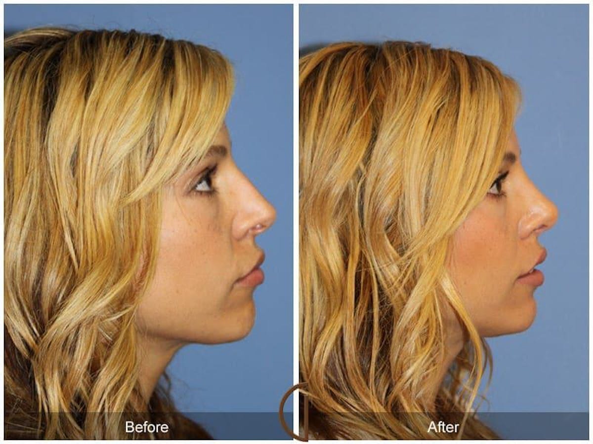 Revision Rhinoplasty Before & After Gallery - Patient 249360 - Image 3