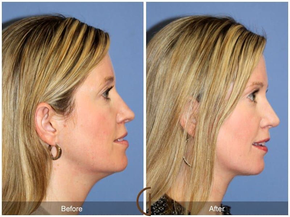 Tip Rhinoplasty Before & After Gallery - Patient 239604 - Image 3