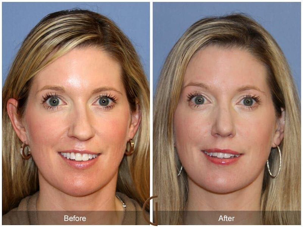 Tip Rhinoplasty Before & After Gallery - Patient 239604 - Image 2
