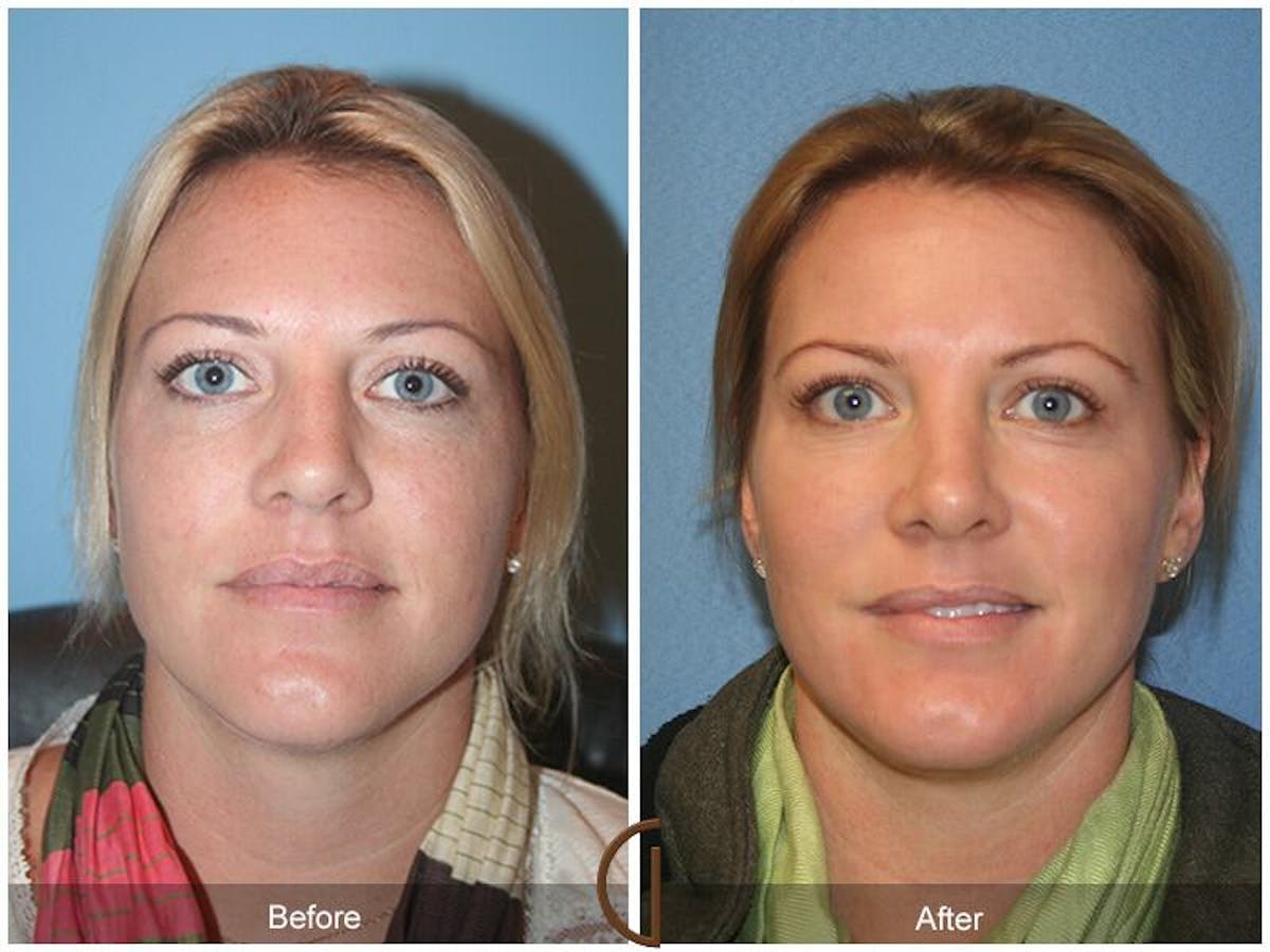 Female Rhinoplasty Before & After Gallery - Patient 336828 - Image 2