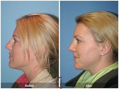 Female Rhinoplasty Before & After Gallery - Patient 336828 - Image 1