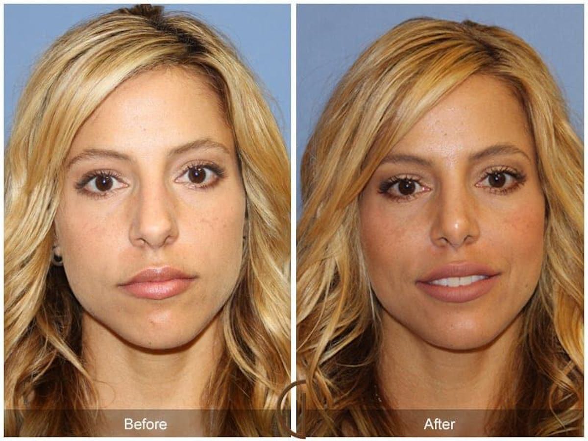 Revision Rhinoplasty Before & After Gallery - Patient 249360 - Image 2