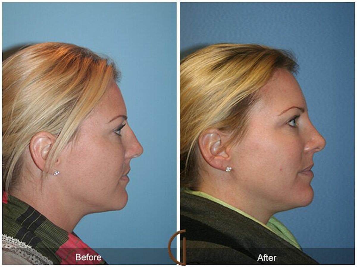 Female Rhinoplasty Before & After Gallery - Patient 336828 - Image 3