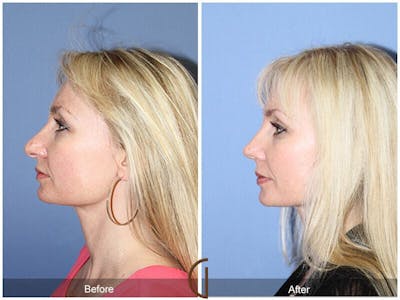 Female Rhinoplasty Before & After Gallery - Patient 815571 - Image 1